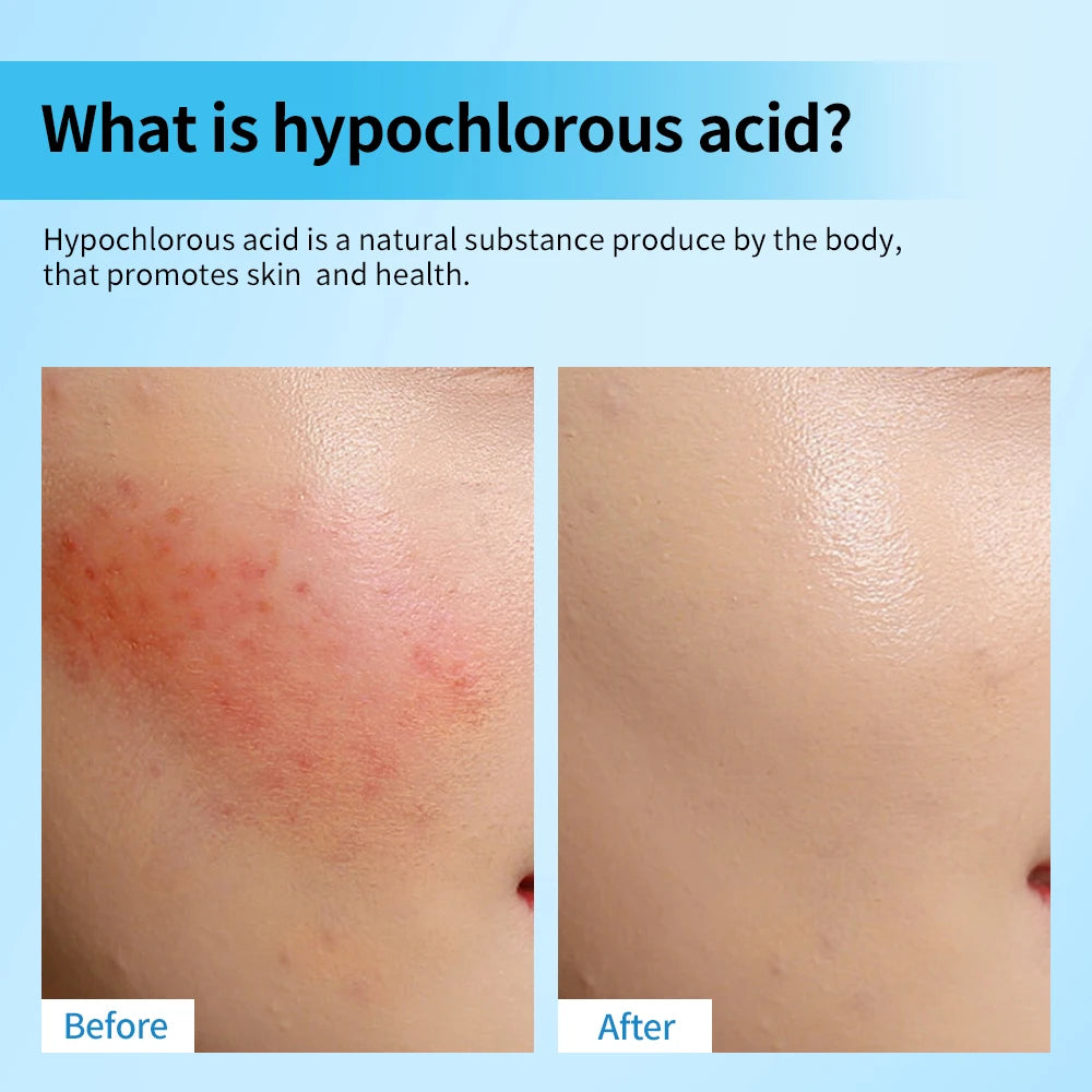 Facial Spray For daily facial Hypochlorous Acid  rescue Reduce redness and acne Versatile uses for every skin need Skin Care